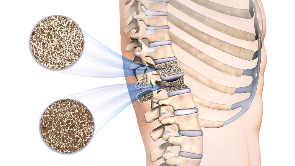 Knochenstoffwechsel / Osteoporose